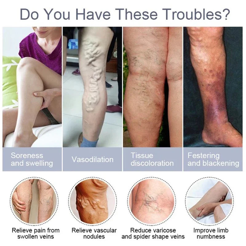 Effective Vein Repair Cream Leg Vein Bulge Pain Maikang Leg Care  Crema Para Blanquear La Cara Skin Whitening Cream 발톱무좀