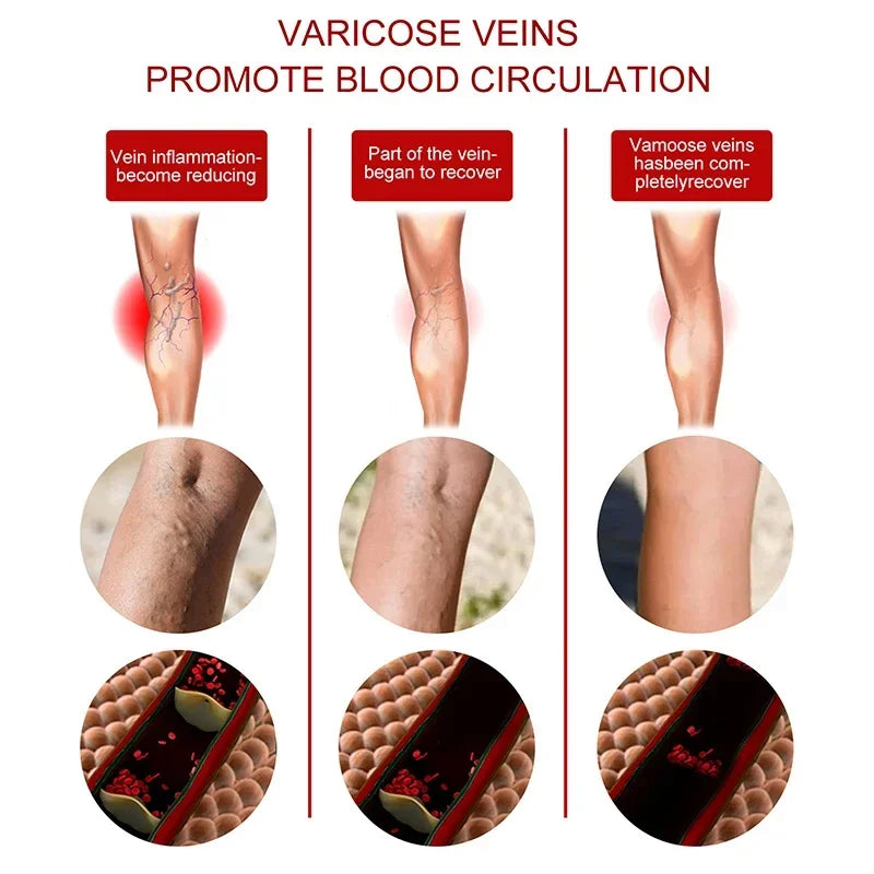 Effective Vein Repair Cream Leg Vein Bulge Pain Maikang Leg Care  Crema Para Blanquear La Cara Skin Whitening Cream 발톱무좀